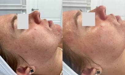 Лечебная чистка + химический пилинг по проблеме  